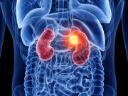 Tivozanib Has Efficacy in Advanced Renal Cell Carcinoma Post-ICI Therapy