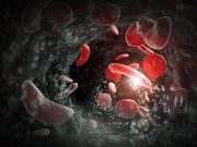 Risk for Stroke, TIA Increased in Adults With Sickle Cell Disease