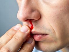 Pomalidomide Efficacious in Hereditary Hemorrhagic Telangiectasia