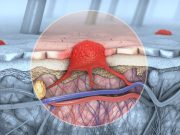 Study Looks at Sex Differences in Melanoma Incidence