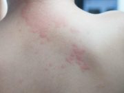 ACAAI: Gene-Editing Therapy Reduces Angioedema Attacks in Hereditary Angioedema