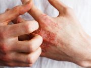 Long-Term Efficacy for Lebrikizumab Seen in Moderate, Severe Eczema