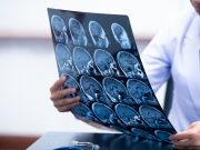 Social Determinants of Health Linked to Receipt of Treatment for Stroke