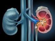 Ultrasonic Propulsion of Residual Kidney Stone Fragments Cuts Relapse