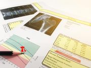 RSNA: Levothyroxine Tied to Bone Loss Over Time in Older Adults