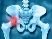 Gabapentinoid Use Tied to Higher Risk for Hip Fractures