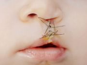 Racial, Ethnic Differences Seen in Cleft Lip Surgery Repair