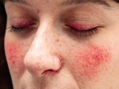 FDA Approves Emrosi for Rosacea in Adults