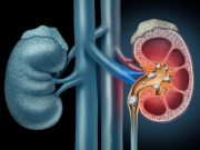 SGLT-2 Inhibitors Beneficial for Patients With Nephrolithiasis