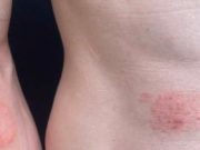 First Cases of Sexually Transmitted Ringworm Reported in the U.S.