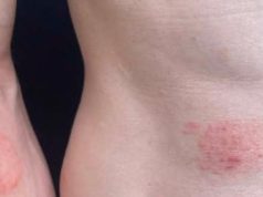 First Cases of Sexually Transmitted Ringworm Reported in the U.S.