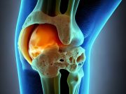 Semaglutide Beneficial for People With Obesity, Knee Osteoarthritis