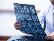 Middle Meningeal Artery Embolization Feasible for Subdural Hematoma