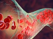 ASH: Reduced-Dose Anticoagulants Not Noninferior for Recurrent VTE