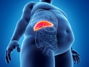 AI Algorithm Can ID Metabolic Dysfunction-Associated Steatotic Liver Disease