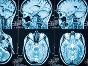 Where One Lives Impacts Dementia Risk