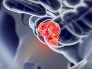 Survival Up With Nivolumab + Ipilimumab Versus Chemo for Metastatic CRC