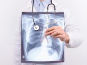 Rurality Partly Explains Racial Difference in Distance to Lung Cancer Screening