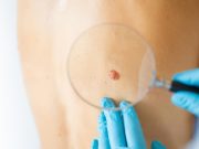 Machine Learning Model Accurately Predicts Survival in Merkel Cell Cancer