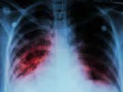Health Officials Alarmed by Tuberculosis Outbreak in Kansas
