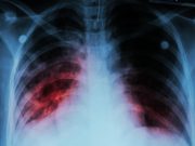 Shorter Treatment Regimens Recommended for Tuberculosis