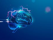 Vagus Nerve Stimulation Shows Positive Treatment Effect in Depression