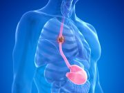 Perioperative Chemo With FLOT Ups Survival in Resectable Esophageal Cancer