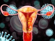 Short-Course Vaginal Cuff Brachytherapy Feasible for Early-Stage Endometrial Cancer