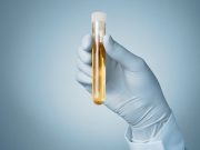 Urine-Based Test Provides Accurate Testing Option for Advanced Prostate Cancer