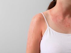 Many U.S. Adults Still Have Misconceptions About Skin Cancer Risk