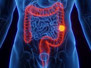 ACC: Colorectal Cancer Tied to Higher Risk for Cardiovascular Death