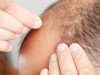 FDA Warns of Unapproved Hair-Loss Product Linked to Side Effects