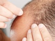 FDA Warns of Unapproved Hair-Loss Product Linked to Side Effects