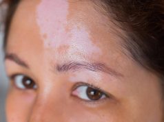 Narrowband UVB Phototherapy Underused for Pediatric Vitiligo