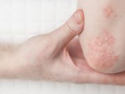Flares Occur Frequently in Generalized Pustular Psoriasis