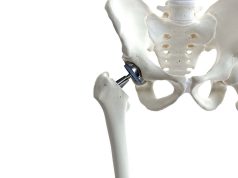 Study IDs Predictors of Biomechanical Function in Patients With OA Undergoing Hip Replacement