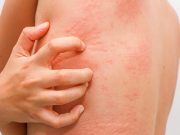 Urticaria Reported in Trial of Investigational HIV mRNA Vaccines