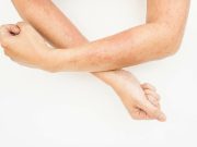 AI Three-Item Severity Score Can ID Eczema From Patient-Uploaded Images