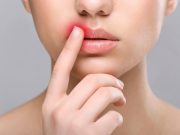 Herpes Simplex Virus Type 1 May Affect Risk for Alzheimer Disease