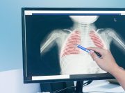 Accurate Risk Prediction Model Developed for Pediatric Pneumonia
