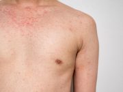 CDC Provides Update on Measles Outbreak in the United States