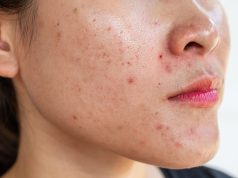 Adult Acne Linked to Higher Risk for Eating Disorders