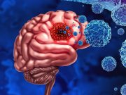 Tumor-Related Epilepsy Not Strong Prognostic Factor in Diffuse Glioma