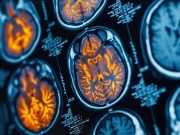 No Negative Psychological Impact Seen for Disclosing Aβ Status