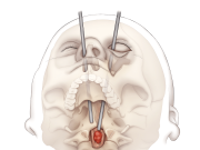 First-of-Its-Kind Surgery Uses Eye Socket to Remove Spinal Cancer