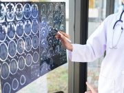 Subarachnoid Bleed One of the Most Common Cardiovascular, Neurologic Causes of Death