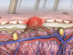 Mitochondrial Genetics Key to Metastatic Melanoma Immunotherapy Resistance