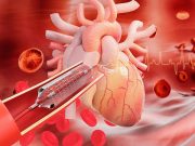 P2Y12 Inhibitor Monotherapy Beneficial for Patients Who Undergo PCI