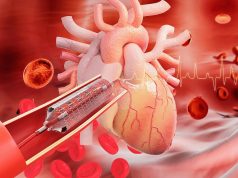 P2Y12 Inhibitor Monotherapy Beneficial for Patients Who Undergo PCI