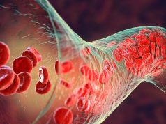 16 Updates, Four New Recommendations Issued for Management of Pediatric VTE